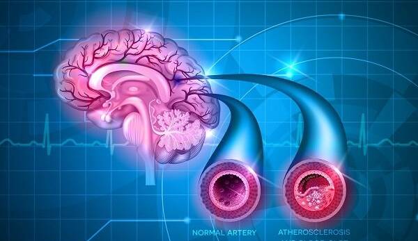 داروهای ضدتهوع ریسک سکته مغزی را افزایش می دهند  
