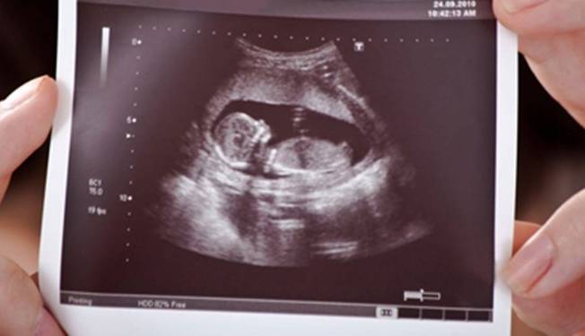 توضیح وزارت بهداشت درباره یک نامه: غربالگری جنین و ثبت آن در سامانه ممنوع نشده است