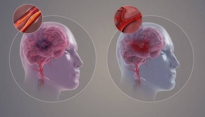 با سکته مغزی، یک سوم امید به زندگی می پرد!