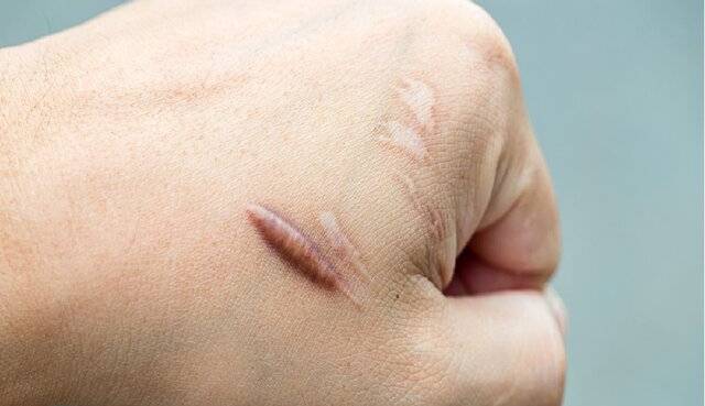 محو کردن جای سوختگی با روش “واتر جت”  