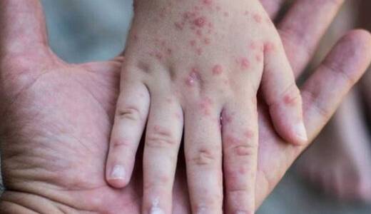 علائم سرخک چیست؛ آن‌ها را جدی بگیرید  