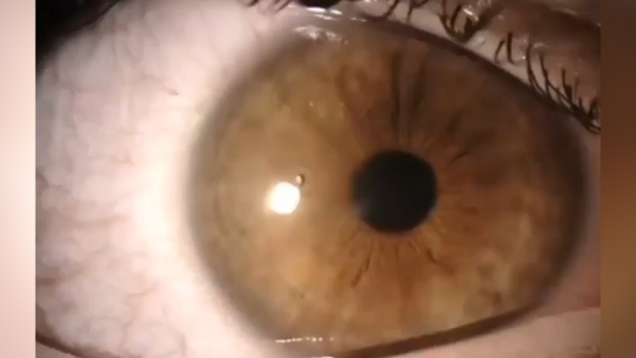 نحوه خارج کردن سنگ ریزه از چشم