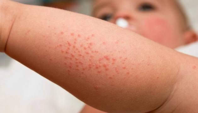 نوعی بیماری پوستی که ابتلا به آن در سنین بالا خطر آلزایمر را بیشتر می کند