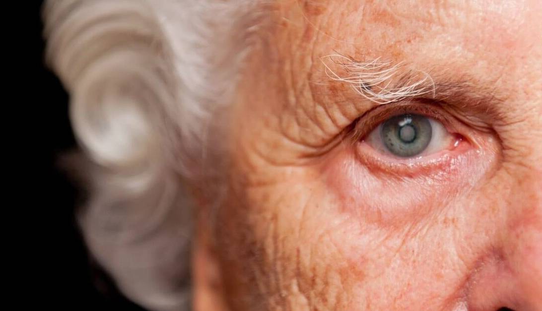 رابطه دیابت با بروز آب مروارید