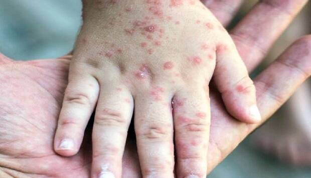 گزارش یک مورد ابتلای کودک ۶ ساله لرستانی به سرخک