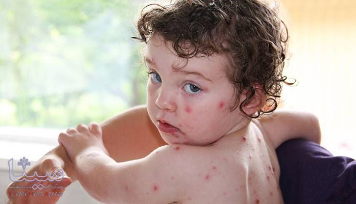 افزایش چشمگیر آبله مرغان در بین کودکان