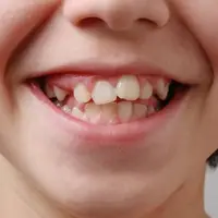 علت اصلی کج شدن دندان های کودکان