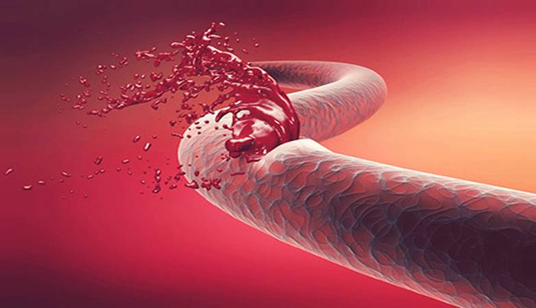 اینفوگرافی؛ هموفیلی و علائم شایع آن اینفوگرافی؛ هموفیلی و علائم شایع آن