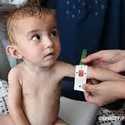 افزایش کودکان دچار سوءتغذیه؛ یونیسف باز هم هشدار داد
