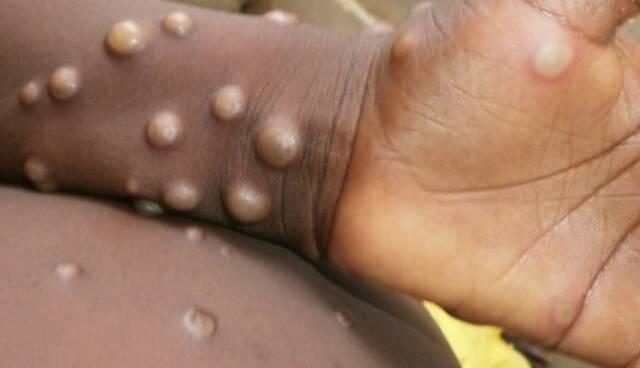 شناسایی موارد جدید ابتلا به آبله میمون در جهان