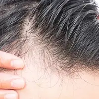 چرا موهای انسان موضعی می ریزد؟