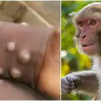 وزارت بهداشت: «آبله میمونی» هنوز به ایران نرسیده است