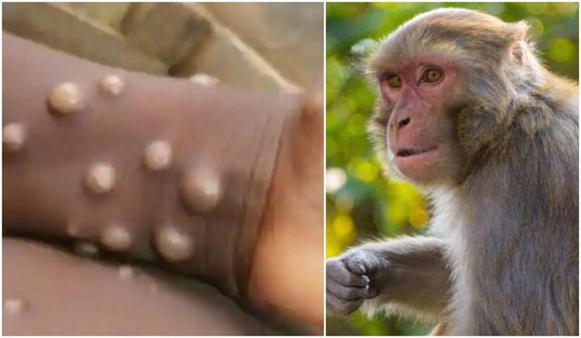 آنچه باید درباره ویروس آبله میمون بدانید