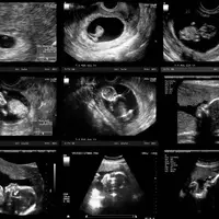 همه چیز درباره سونوگرافی‌های دوران بارداری  