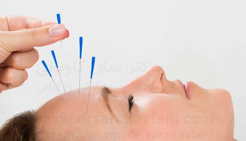 برای سردرد از طب سوزنی کمک بگیرید