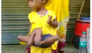 دختری عجیب الخلقه با 8 دست و پا