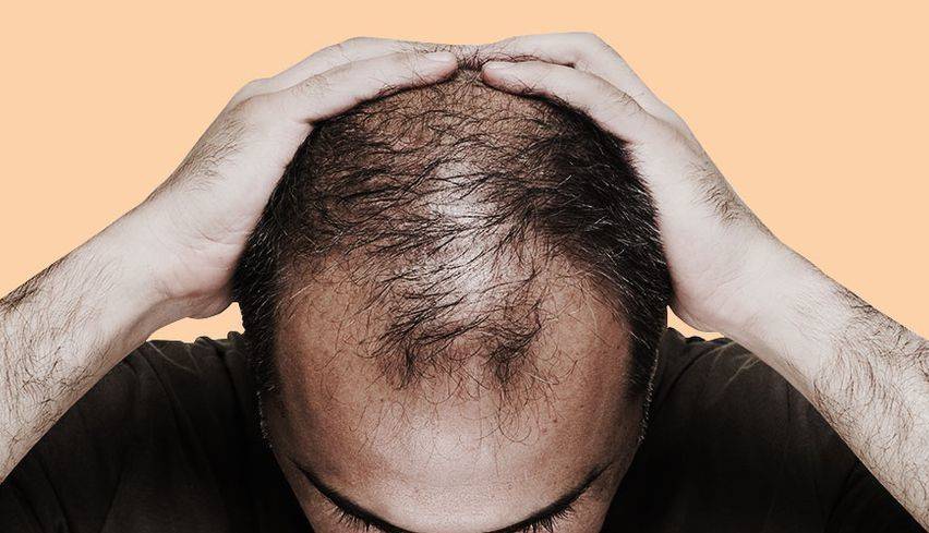 شایع ترین دلیل ریزش مو بین آقایون چیست؟