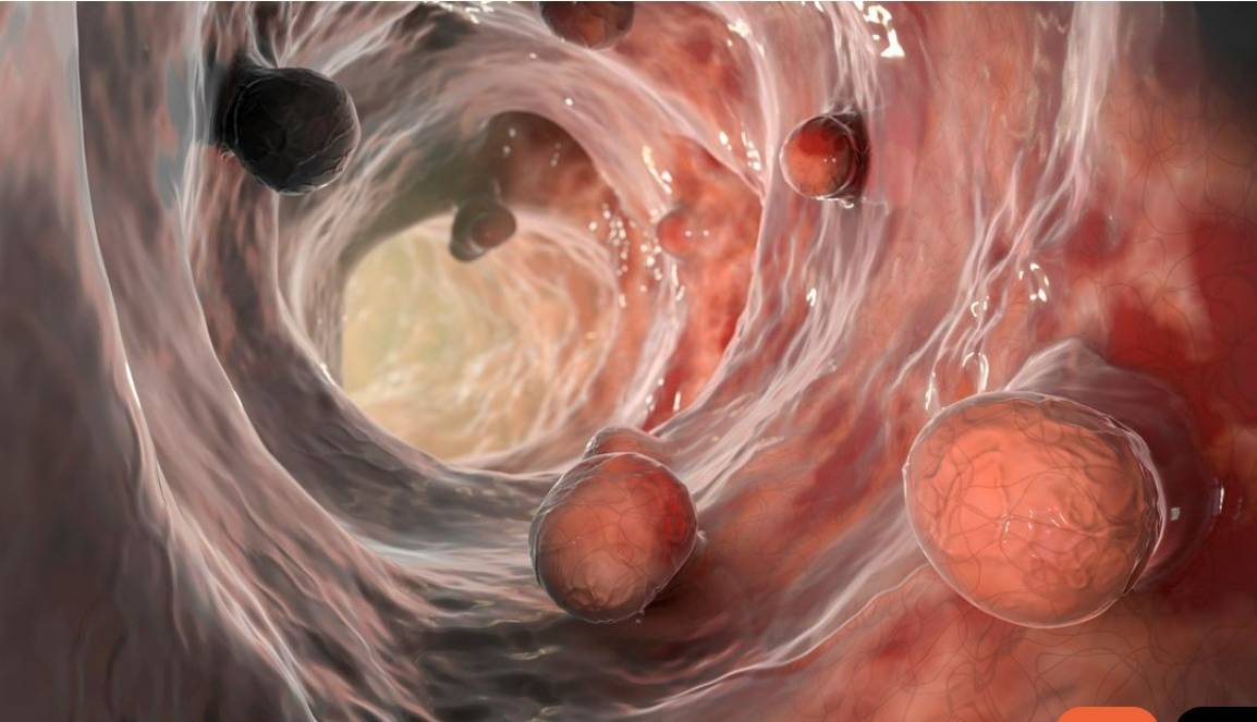 علائم غیرمعمول سرطان را بشناسید؛ از تعریق شدید شبانه تا نقاط ریز روی ناخن!