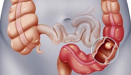 اینفوگرافی؛ اگر یبوست دارید، این غذاها را نخورید!  