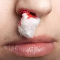 علت خونریزی بینی چیست و چطور می توان از آن جلوگیری کرد؟