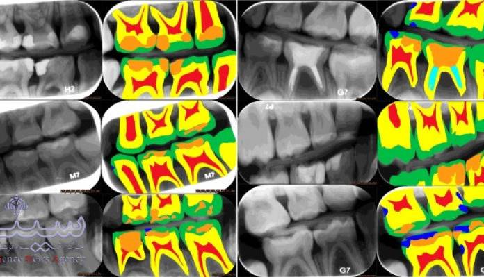 تشخیص پوسیدگی دندان با پشتیبانی هوش مصنوعی