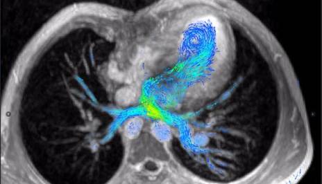 MRI چهاربعدی، انقلابی در تشخیص نارسایی عروق خونی قلب