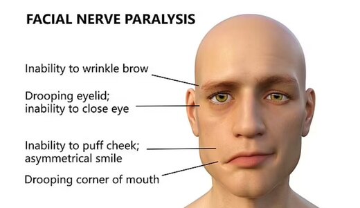 علت فلج عصب صورت چیست؟