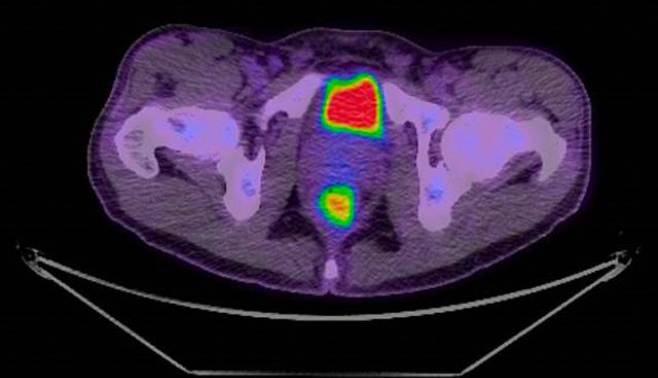 کمک به بیماران مبتلا به سرطان خون با اسکن های هوشمند PET/CT