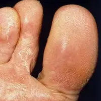 درمان کچلی پا با ضدعفونی کردن جوراب