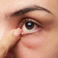 التهاب و خارش چشم چه دلایلی دارد؟
