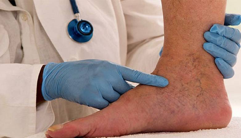 چرا تشخیص واریس اهمیت دارد؟  