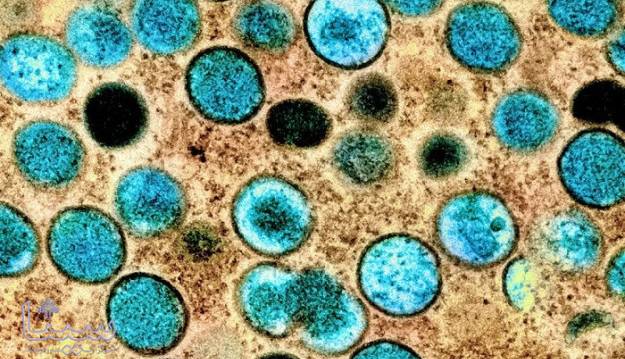 شناسایی ویروس آبله میمونی در ترشحات جنسی بیماران