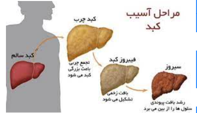 هشدار متخصصان درباره شیوع بالای کبد چرب