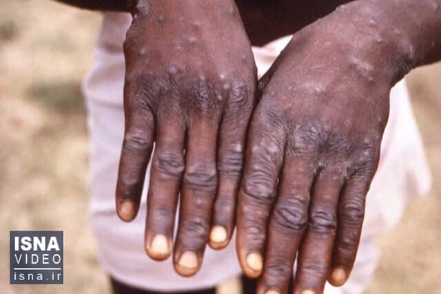 آبله میمون در وضعیت اضطراری جهانی