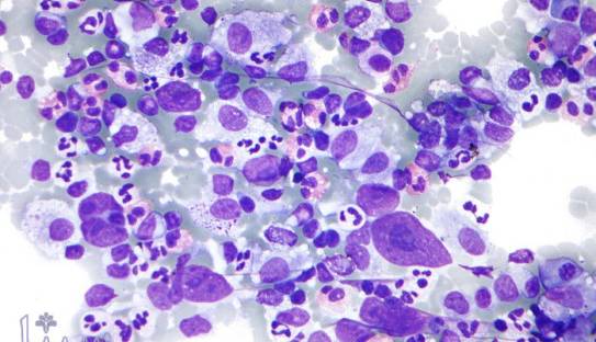 ایست قلبی در کمین افراد مبتلا به سرطان سیستم لنفاوی