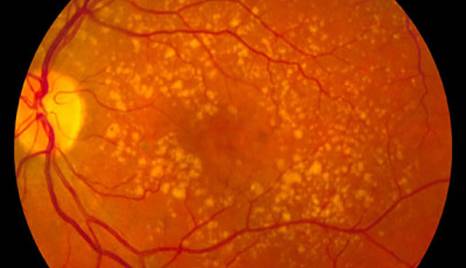 کشف مبنای ژنتیکی بیماری تخریب لکه زرد چشم