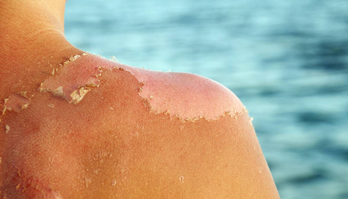 5 ماده غذایی برای درمان آفتاب‌سوختگی