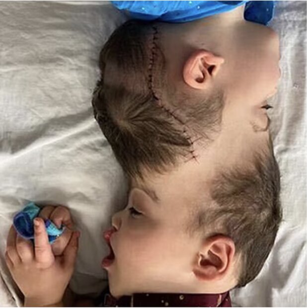 دوقلوهای بهم چسبیده برزیلی با کمک واقعیت مجازی از یکدیگر جدا شدند  