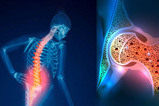 پوکی استخوان عامل ۴۲۰۰ مرگ و میر سالانه در کشور  