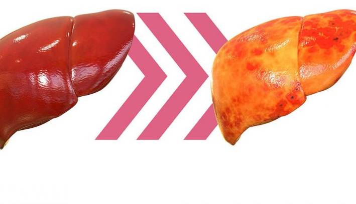 راه حل عمومی برای درمان کبد چرب