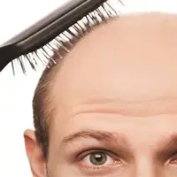 واقعیت‌هایی در مورد ریزش مو؛ ۸ باور اشتباه که باید فراموش کنید