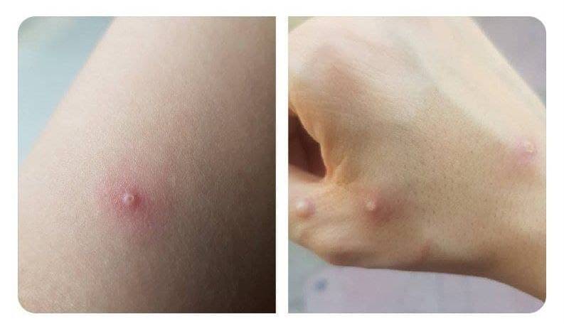 تصاویر ضایعه پوستی بیمار مبتلا آبله میمونی در ایران