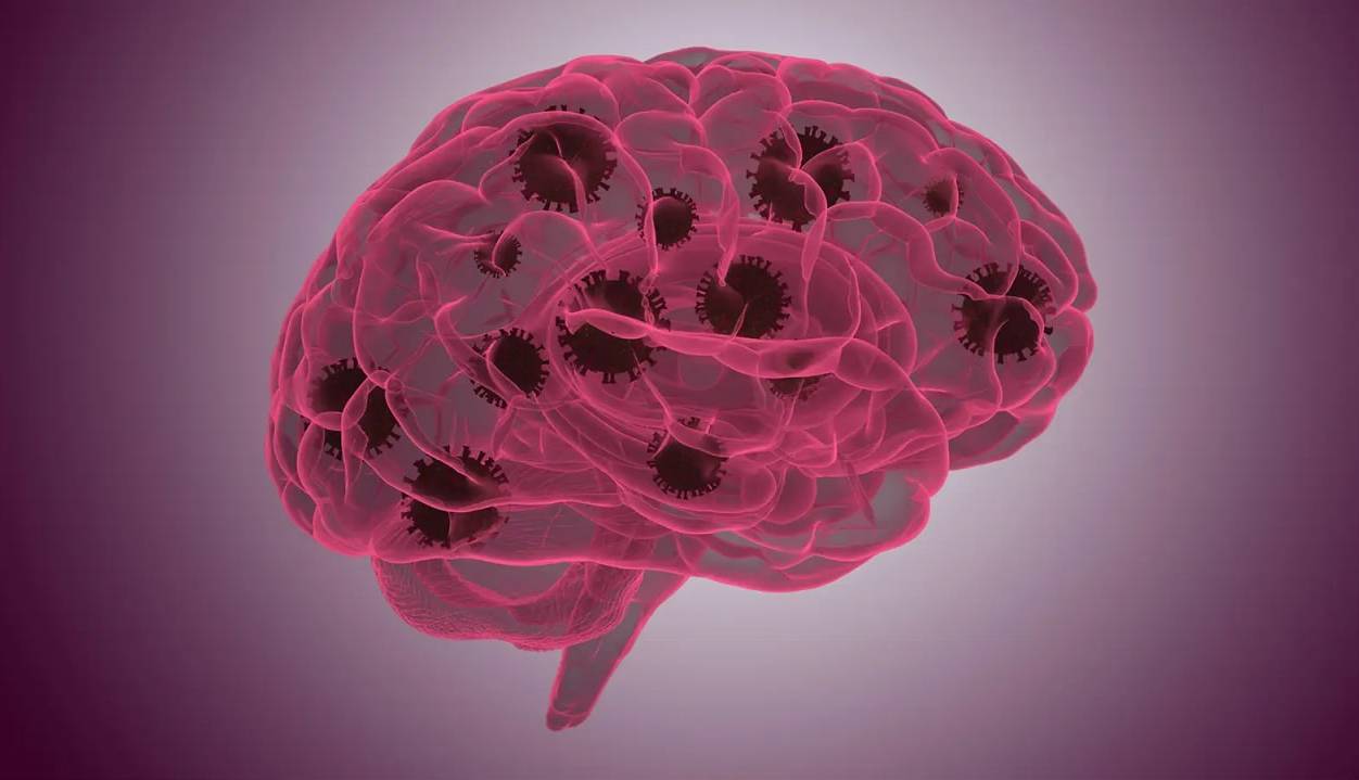 دوسال پس از بهبودی کرونا همچنان در معرض مه مغزی و زوال عقل