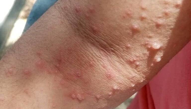 شباهت‌های علائم آبله میمونی و آبله مرغان را بشناسید