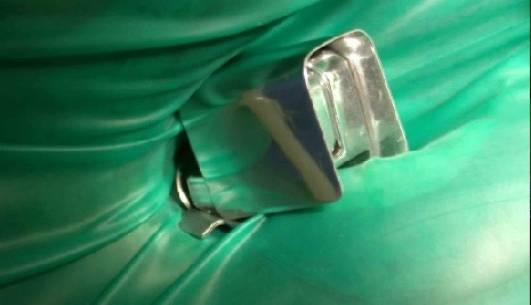 پر کردن و عصب کشی دندان به کمک میکرو روبات