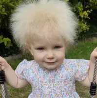 کودک ۱۷ ماهه‌ای که مبتلا به سندرم موهای شانه نشدنی است