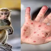 آخرین آمار مبتلایان به آبله میمونی در جهان
