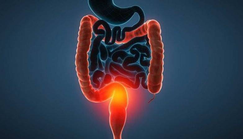 نکات طلایی در پیشگیری از سرطان روده