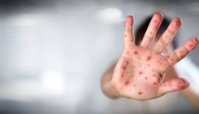 آیا آبله میمونی، به مشکلات قلبی می انجامد؟
