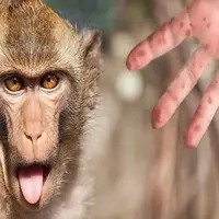 ردپای آبله میمونی در 105 کشور دنیا 